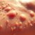 Fotodermatoza egzogenna – objawy, przyczyny i jak zapobiegać?